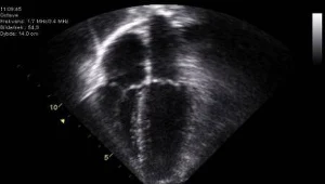 Typowy obraz echokardiograficzny, ? Kjetil Lenes, Creative Commons