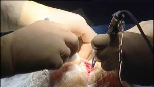 Operacja wszczepienia implantu zastępującego krążki międzykręgowe kręgosłupa