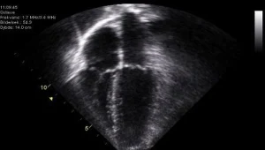 Co setny człowiek nosi genu ataku serca