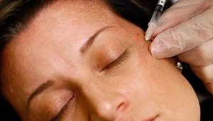 Botoks cudownym lekiem XXI wieku?