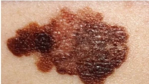 Chorzy na parkinsona częściej mają czerniaka