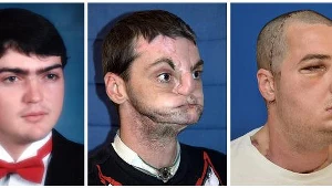 To największa rekonstrukcja twarzy w historii medycyny