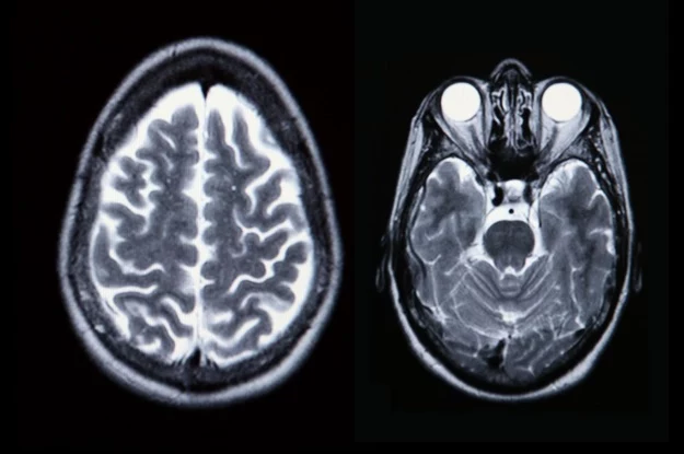Skany mózgu mogą wskazać dysfunkcje połączeń nerwowych