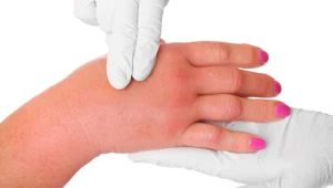 Mogą wywołać u ludzi chorobę skóry 