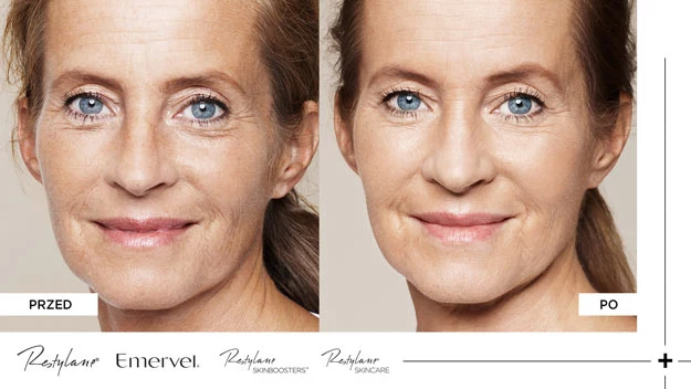 Restylane - Przed i po Restylane - Przed i po