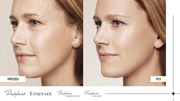 Restylane. Przed i po. http://akcjarestylane.pl/r/interia/stylpl/index.html Restylane. Przed i po. http://akcjarestylane.pl/r/interia/stylpl/index.html