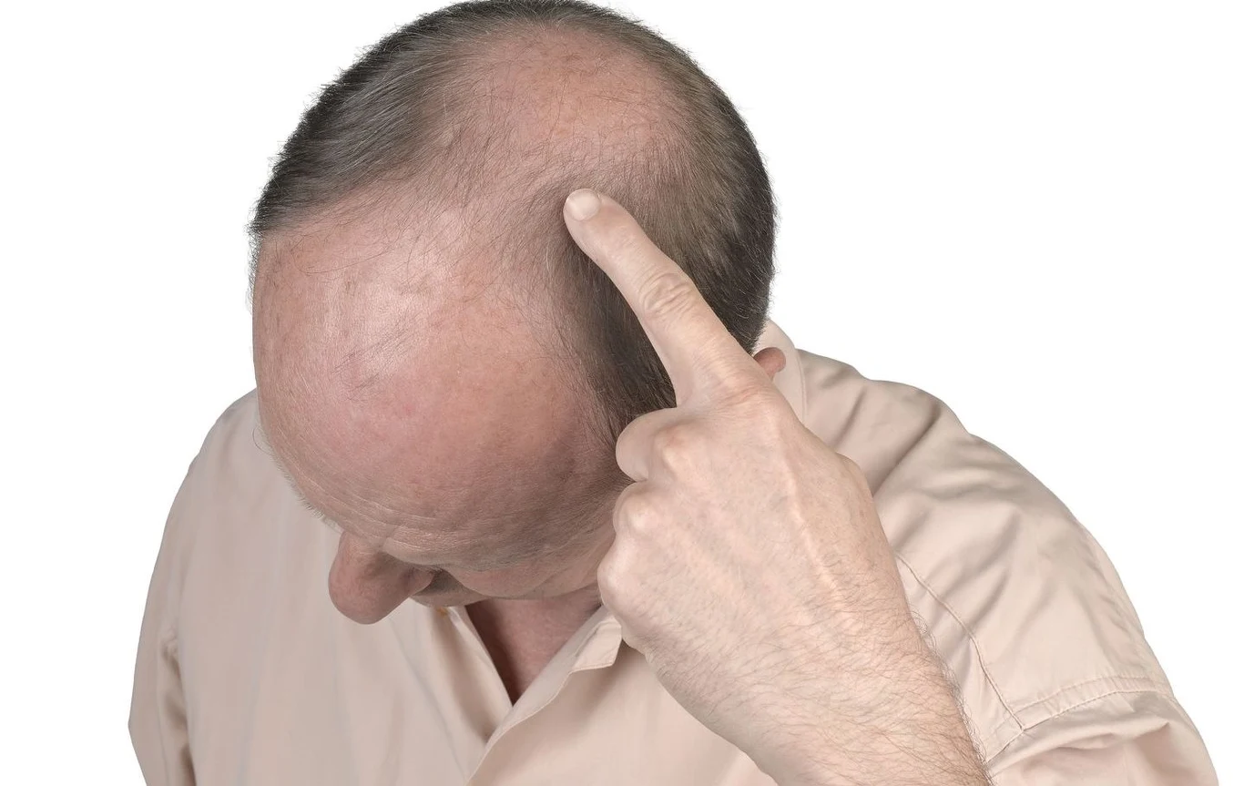 Tani i naturalny cukier potencjalnie lepszy od leków na łysienie Tani i naturalny cukier potencjalnie lepszy od leków na łysienie