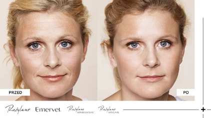 Restylane - Przed i po Restylane - Przed i po