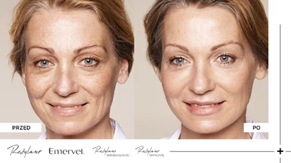 Restylane - Przed i po Restylane - Przed i po