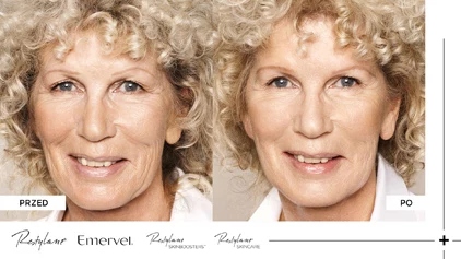 Restylane - Przed i po Restylane - Przed i po