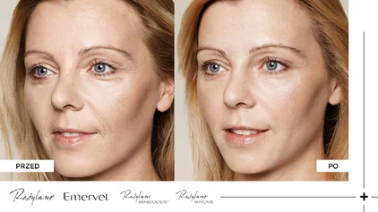 Restylane - Przed i po Restylane - Przed i po