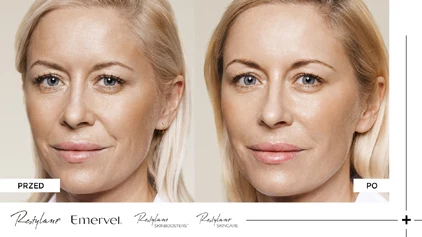 Restylane - Przed i po Restylane - Przed i po