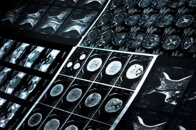 Mechanizmy powstawania zepsołu AT są podobne do Parkinsona i Alzheimera Mechanizmy powstawania zepsołu AT są podobne do Parkinsona i Alzheimera