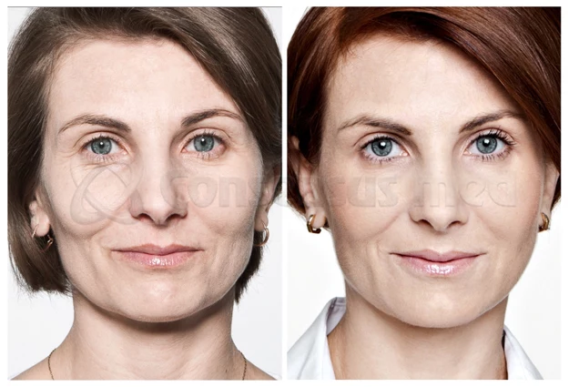 Restylane - przed i po Restylane - przed i po