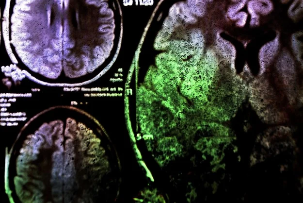 Czy choroby neurodegeneracyjne można leczyć laserem? Polak Piotr Hańczyc twierdzi, że tak Czy choroby neurodegeneracyjne można leczyć laserem? Polak Piotr Hańczyc twierdzi, że tak