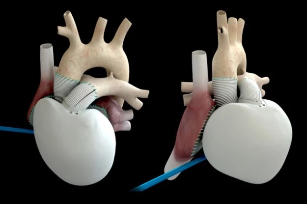 Carmat Heart