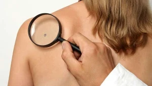 Pieprzyki cyasami przeistaczają się w zmianę nowotworową