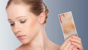 Objawy zapalenia powinien ocenić dermatolog