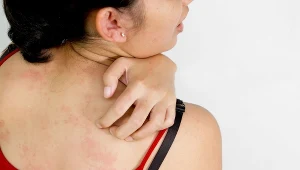 Atopowe zapalenie skóry może objawiać się na wiele sposobów