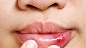 Gdy cierpimy z powodu nawrotów aft, warto zwrócić się do dietetyka z prośbą o przeanalizowanie naszego jadłospisu i sprawdzenie, czy zawiera dostateczne ilości kwasu foliowego, żelaza, cynku i witaminy B12