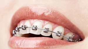 Higiena jamy ustnej u osób noszących aparaty stałe jest sprawą niezwykle ważną i trzeba poświęcić na nią znacznie więcej czasu