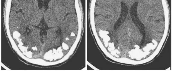 Kamienie mózgowe to efekt nieleczonej celiakii (Fot. The New England Journal of Medicine)