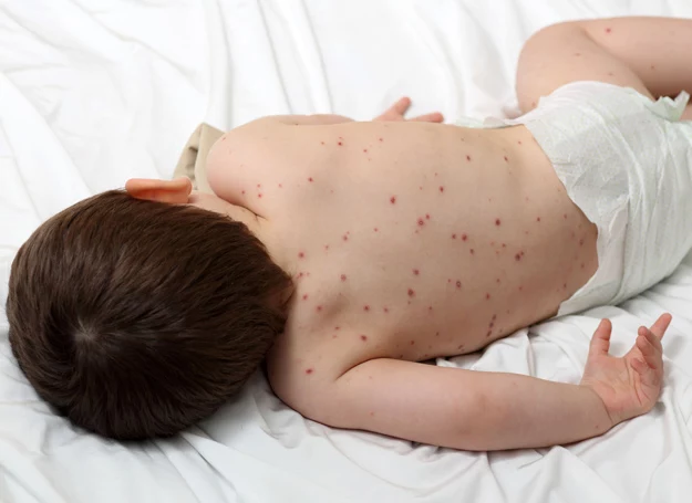 Kiedy wysypka nie znika, koniecznie skonsultuj się z pediatrą. Kiedy wysypka nie znika, koniecznie skonsultuj się z pediatrą.