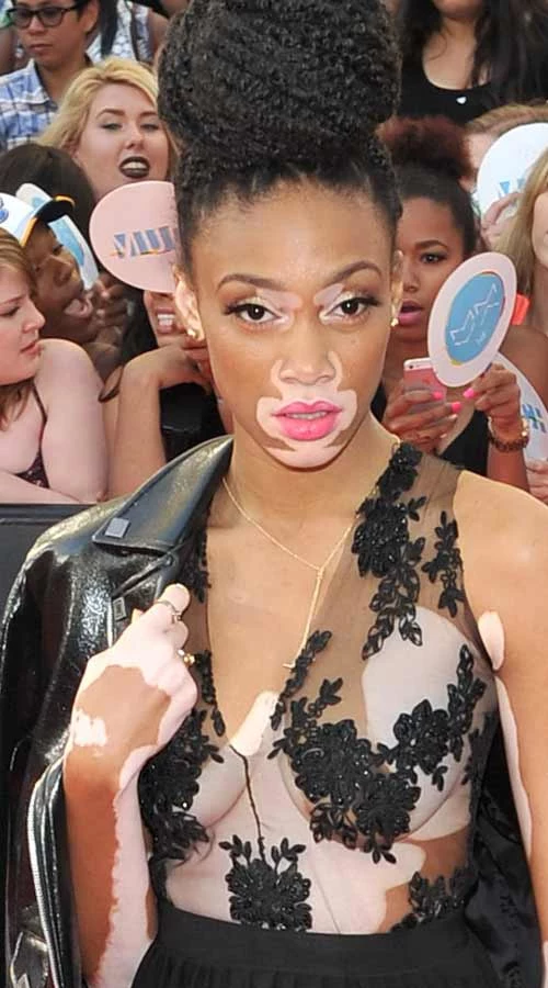 Winnie Harlow 