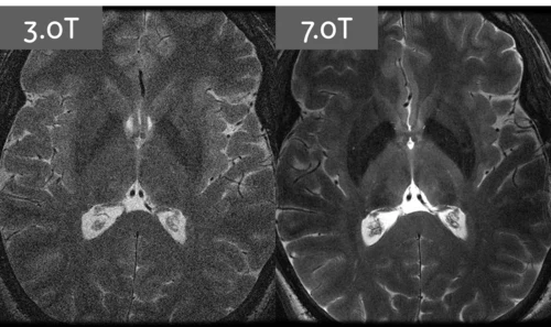 Po lewej zdjęcie uzyskane magnesem 3T (Tesli), po prawej 7T - różnica jest kolosalna