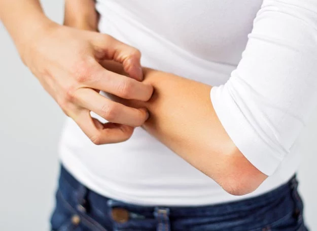 Maść propolisowa może wywoływać alergię. Wykonaj prosty test, by uniknąć przykrej niespodzianki
