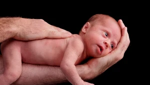 Ciemieniucha jest efektem nadmiernej pracy gruczołów łojowych