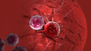 Glejak wielopostaciowy to jedna z najcięższych postaci raka mózgu