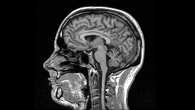 Dzięki badaniom MRI naukowcom udało się na nowo odkryć pionowy pęczek potyliczny