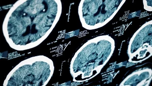 W Krakowie rozpoczął się kongres neurochirurgów