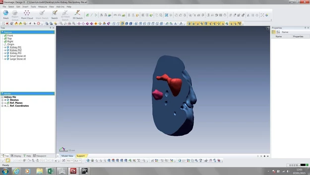 John Cousins pomógł lekarzom przeprowadzić operację na nim samym projektując model 3D swojej nerki