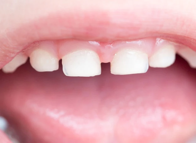 Diastema może, ale wcale nie musi wpłynąć na sposób wymawiania niektórych głosek. 