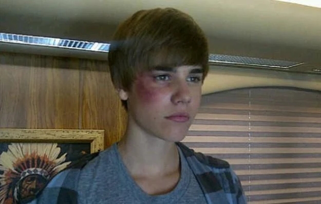 Justin Bieber i jego imponujący, sztuczny siniak Justin Bieber i jego imponujący, sztuczny siniak