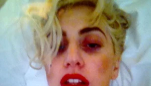 Lady Gaga wciąż odczuwa skutki uderzenia