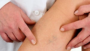 Zakrzepica zabija po cichu. Często objawy zauważamy zbyt późno