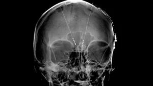 Implanty w mózgu przywrócą pamięć