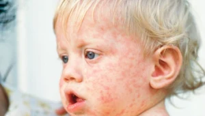 Dziecko chore na odrę - zdjęcie ilustracyjne