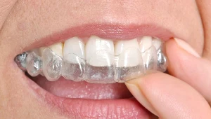 Moda na niewidoczne aparaty przyszła prosto z USA