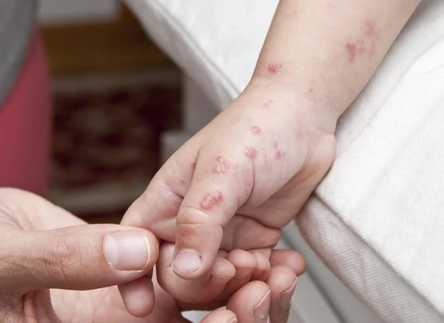 Wstrząs anafilaktyczny może wywołać m.in. użądlenie pszczoły 
