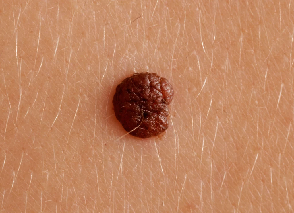 Badanie dermoskopowe inaczej dermatoskopowe, powinno być wykonane kompleksowo Badanie dermoskopowe inaczej dermatoskopowe, powinno być wykonane kompleksowo