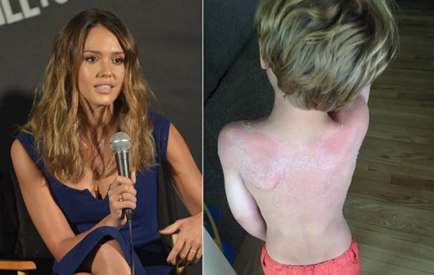 Jessica Alba jest współwłaścicielka firmy, której kosmetyki spowodowały poparzenia słoneczne u dzieci Jessica Alba jest współwłaścicielka firmy, której kosmetyki spowodowały poparzenia słoneczne u dzieci
