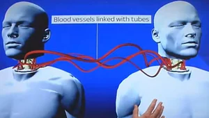 Dokonają niemożliwego? Przeszczep głowy już w 2017 roku!