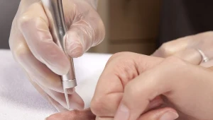 Usuwanie brodawek laserem