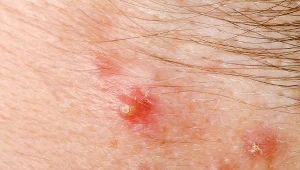 Czyraki to efekt ropnego zapalenia mieszków włosowych