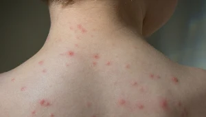 Powikłania po różyczce mogą być bardzo niebezpieczne