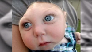 13 -miesięczny Jaxon żyje i się rozwija, mimo ze nie ma połowy czaszki